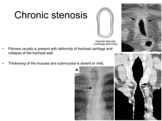 39
Chronic stenosis
• Fibrosis usually is present with deformity of tracheal cartilage and
collapse of the tracheal wall.
• Thickening of the mucosa and submucosa is absent or mild,
 