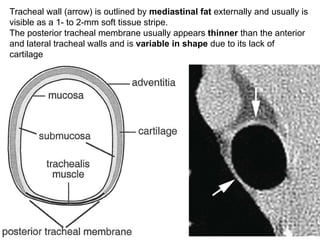 5
Tracheal wall (arrow) is outlined by mediastinal fat externally and usually is
visible as a 1- to 2-mm soft tissue stripe.
The posterior tracheal membrane usually appears thinner than the anterior
and lateral tracheal walls and is variable in shape due to its lack of
cartilage
 
