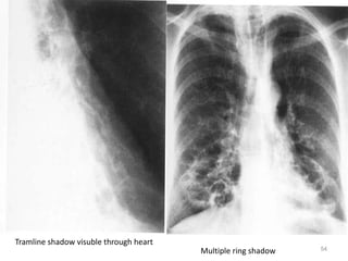 54
• X ray photo
Multiple ring shadow
Tramline shadow visuble through heart
 
