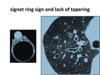 56
signet ring sign and lack of tapering
 