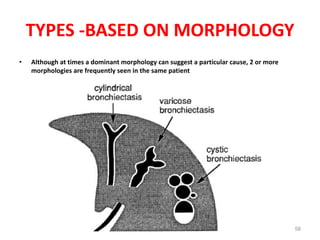 58
TYPES -BASED ON MORPHOLOGY
• Although at times a dominant morphology can suggest a particular cause, 2 or more
morphologies are frequently seen in the same patient
 