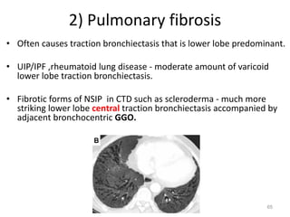 65
2) Pulmonary fibrosis
• Often causes traction bronchiectasis that is lower lobe predominant.
• UIP/IPF ,rheumatoid lung disease - moderate amount of varicoid
lower lobe traction bronchiectasis.
• Fibrotic forms of NSIP in CTD such as scleroderma - much more
striking lower lobe central traction bronchiectasis accompanied by
adjacent bronchocentric GGO.
 
