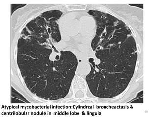 69
Atypical mycobacterial infection:Cylindrcal broncheactasis &
centrilobular nodule in middle lobe & lingula
 