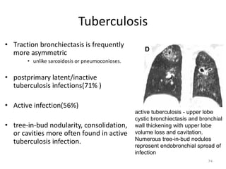 74
Tuberculosis
• Traction bronchiectasis is frequently
more asymmetric
• unlike sarcoidosis or pneumoconioses.
• postprimary latent/inactive
tuberculosis infections(71% )
• Active infection(56%)
• tree-in-bud nodularity, consolidation,
or cavities more often found in active
tuberculosis infection.
active tuberculosis - upper lobe
cystic bronchiectasis and bronchial
wall thickening with upper lobe
volume loss and cavitation.
Numerous tree-in-bud nodules
represent endobronchial spread of
infection
 