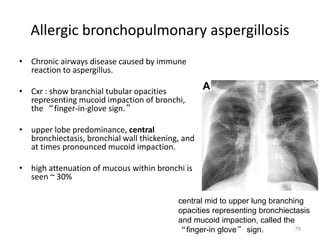 75
Allergic bronchopulmonary aspergillosis
• Chronic airways disease caused by immune
reaction to aspergillus.
• Cxr : show branchial tubular opacities
representing mucoid impaction of bronchi,
the “finger-in-glove sign.”
• upper lobe predominance, central
bronchiectasis, bronchial wall thickening, and
at times pronounced mucoid impaction.
• high attenuation of mucous within bronchi is
seen ~ 30%
central mid to upper lung branching
opacities representing bronchiectasis
and mucoid impaction, called the
“finger-in glove” sign.
 