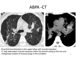 76
ABPA -CT
B,central bronchiectasis in the upper lobes with mucoid impaction.
C, high attenuation mucoid impaction within the bronchi owing to the iron and
manganese content of mucous plugs in this condition.
 