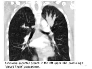 77
Aspeilosis. impacted bronchi in the left upper lobe producing a
“gloved finger” appearance.
 