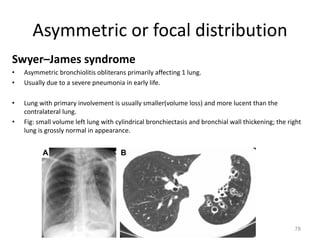 78
Asymmetric or focal distribution
Swyer–James syndrome
• Asymmetric bronchiolitis obliterans primarily affecting 1 lung.
• Usually due to a severe pneumonia in early life.
• Lung with primary involvement is usually smaller(volume loss) and more lucent than the
contralateral lung.
• Fig: small volume left lung with cylindrical bronchiectasis and bronchial wall thickening; the right
lung is grossly normal in appearance.
 