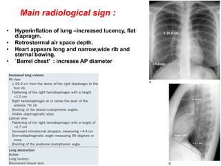 83
• Hyperinflation of lung –increased lucency, flat
diapragm.
• Retrosterrnal air space depth.
• Heart appears long and narrow,wide rib and
sternal bowing.
• `Barrel chest' : increase AP diameter
Main radiological sign :
 