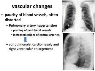 84
vascular changes
• paucity of blood vessels, often
distorted
– Pulmonary artery hypertension
• pruning of peripheral vessels.
• increased caliber of central arteries.
– cor pulmonale :cardiomegaly and
right ventricular enlargement
 