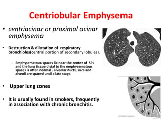 86
Centriobular Emphysema
• centriacinar or proximal acinar
emphysema
• Destruction & dilatation of respiratory
bronchioles(central portion of secondary lobules).
– Emphysematous spaces lie near the center of SPL
and the lung tissue distal to the emphysematous
spaces is often normal . alveolar ducts, sacs and
alveoli are spared until a late stage.
• Upper lung zones
• It is usually found in smokers, frequently
in association with chronic bronchitis.
 