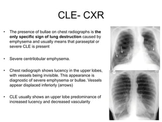 87
• The presence of bullae on chest radiographs is the
only specific sign of lung destruction caused by
emphysema and usually means that paraseptal or
severe CLE is present
• Severe centrilobular emphysema.
• Chest radiograph shows lucency in the upper lobes,
with vessels being invisible. This appearance is
diagnostic of severe emphysema or bullae. Vessels
appear displaced inferiorly (arrows)
• CLE usually shows an upper lobe predominance of
increased lucency and decreased vascularity
CLE- CXR
 