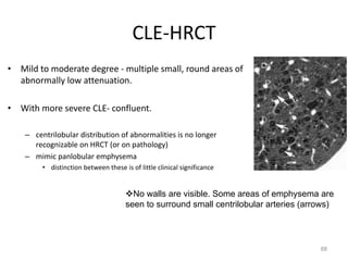 88
CLE-HRCT
• Mild to moderate degree - multiple small, round areas of
abnormally low attenuation.
• With more severe CLE- confluent.
– centrilobular distribution of abnormalities is no longer
recognizable on HRCT (or on pathology)
– mimic panlobular emphysema
• distinction between these is of little clinical significance
vNo walls are visible. Some areas of emphysema are
seen to surround small centrilobular arteries (arrows)
 