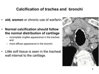 9
Calcification of trachea and bronchi
• old, women or chronic use of warfarin.
• Normal calcification should follow
the normal distribution of cartilage
– incomplete ringlike appearance in the trachea
and
– more diffuse appearance in the bronchi.
• Little soft tissue is seen in the tracheal
wall internal to the cartilage.
 