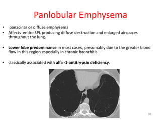 91
Panlobular Emphysema
• panacinar or diffuse emphysema
• Affects entire SPL producing diffuse destruction and enlarged airspaces
throughout the lung.
• Lower lobe predominance in most cases, presumably due to the greater blood
flow in this region especially in chronic bronchitis.
• classically associated with alfa -1-antitrypsin deficiency.
 