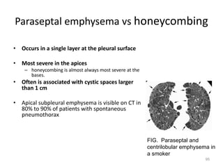 95
• Occurs in a single layer at the pleural surface
• Most severe in the apices
– honeycombing is almost always most severe at the
bases.
• Often is associated with cystic spaces larger
than 1 cm
• Apical subpleural emphysema is visible on CT in
80% to 90% of patients with spontaneous
pneumothorax
Paraseptal emphysema vs honeycombing
FIG. Paraseptal and
centrilobular emphysema in
a smoker
 