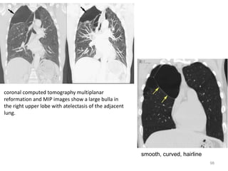 98
coronal computed tomography multiplanar
reformation and MIP images show a large bulla in
the right upper lobe with atelectasis of the adjacent
lung.
smooth, curved, hairline
 