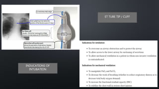 ET TUBE TIP / CUFF
INDUCATIONS OF
INTUBATION
 