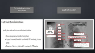 Contraindications to
intubaton Depth of insertion
 