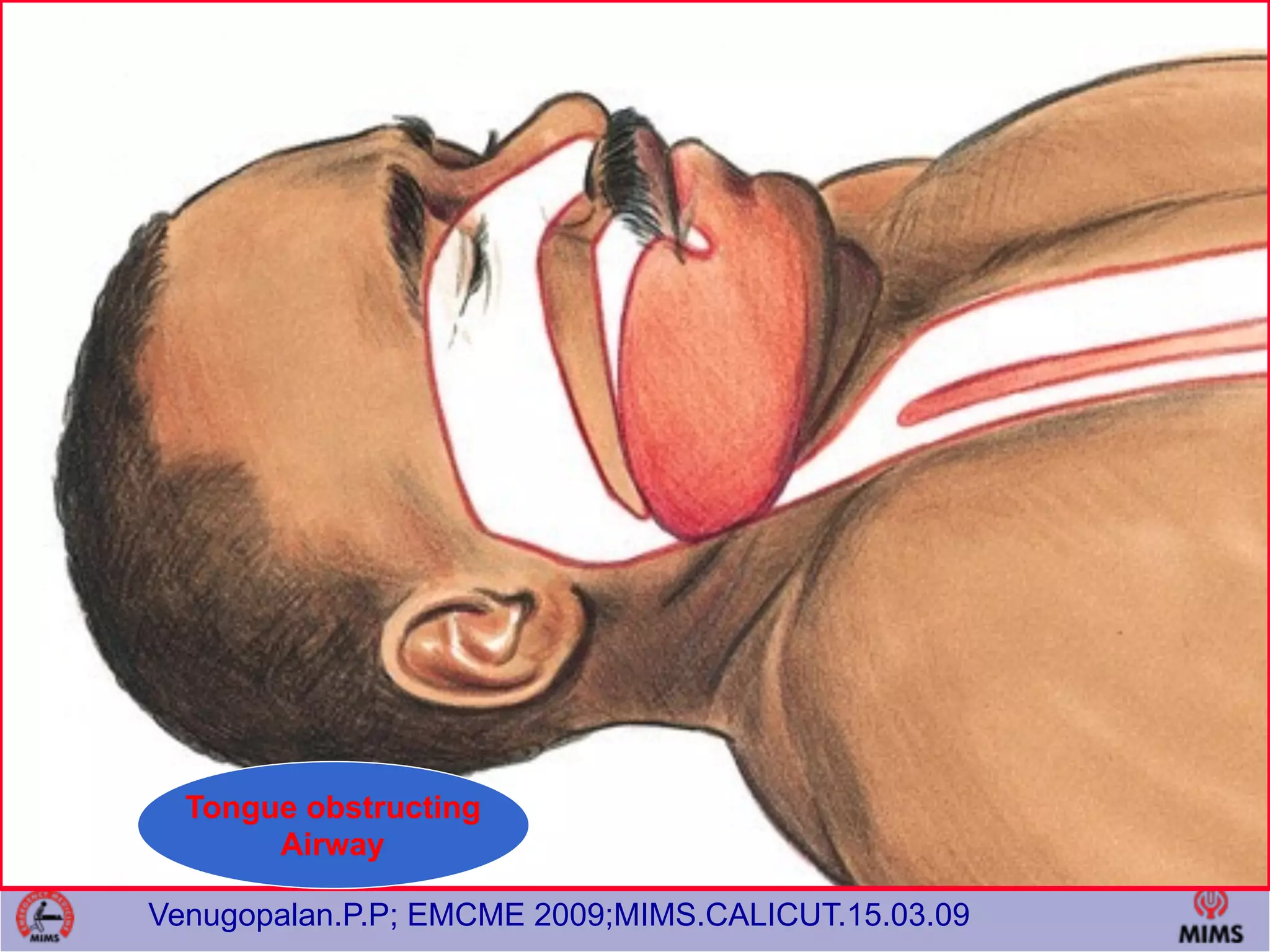 Venugopalan.P.P; EMCME 2009;MIMS.CALICUT.15.03.09
Tongue obstructing
Airway
 