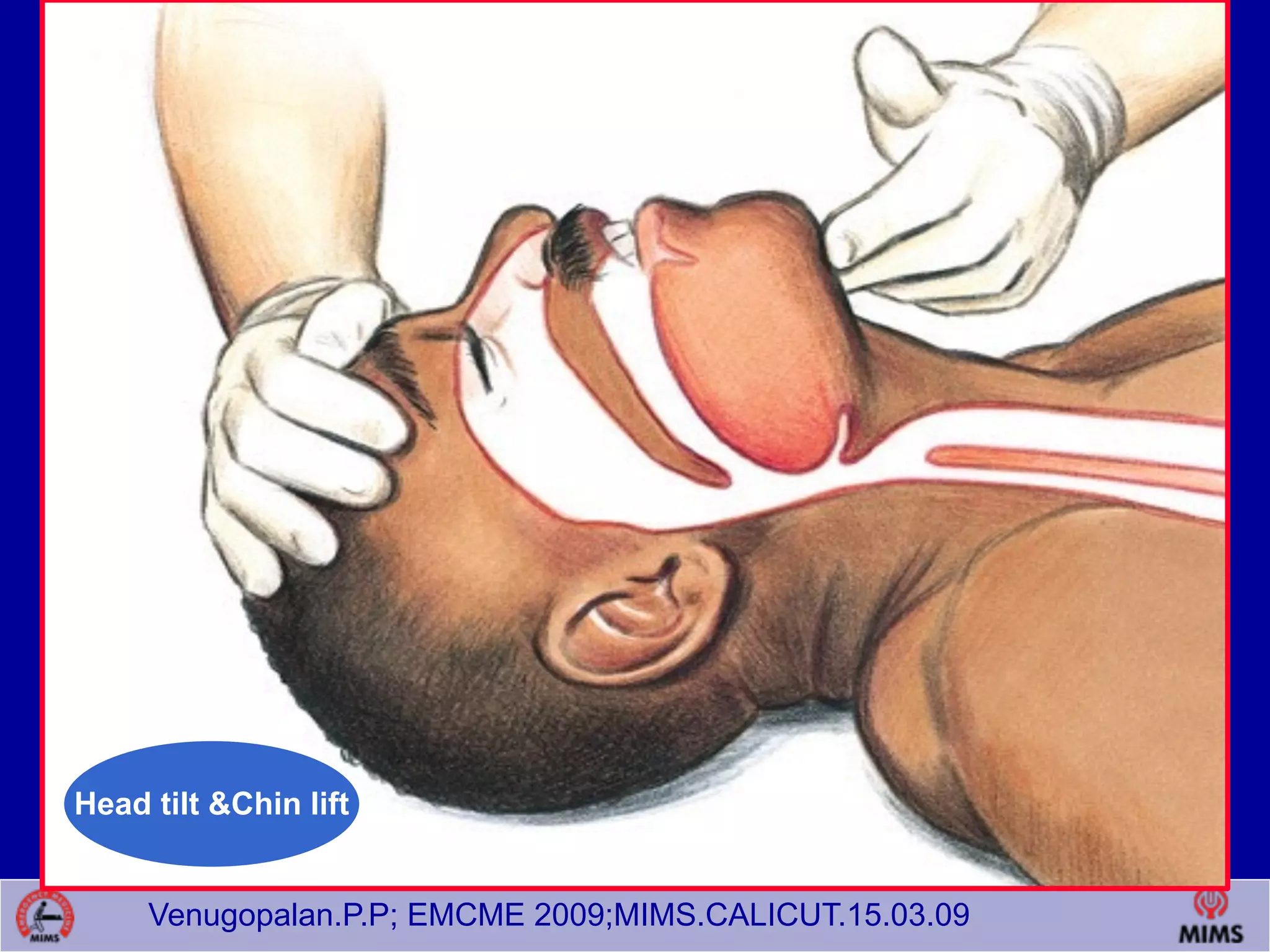 Venugopalan.P.P; EMCME 2009;MIMS.CALICUT.15.03.09
Head tilt &Chin lift
 