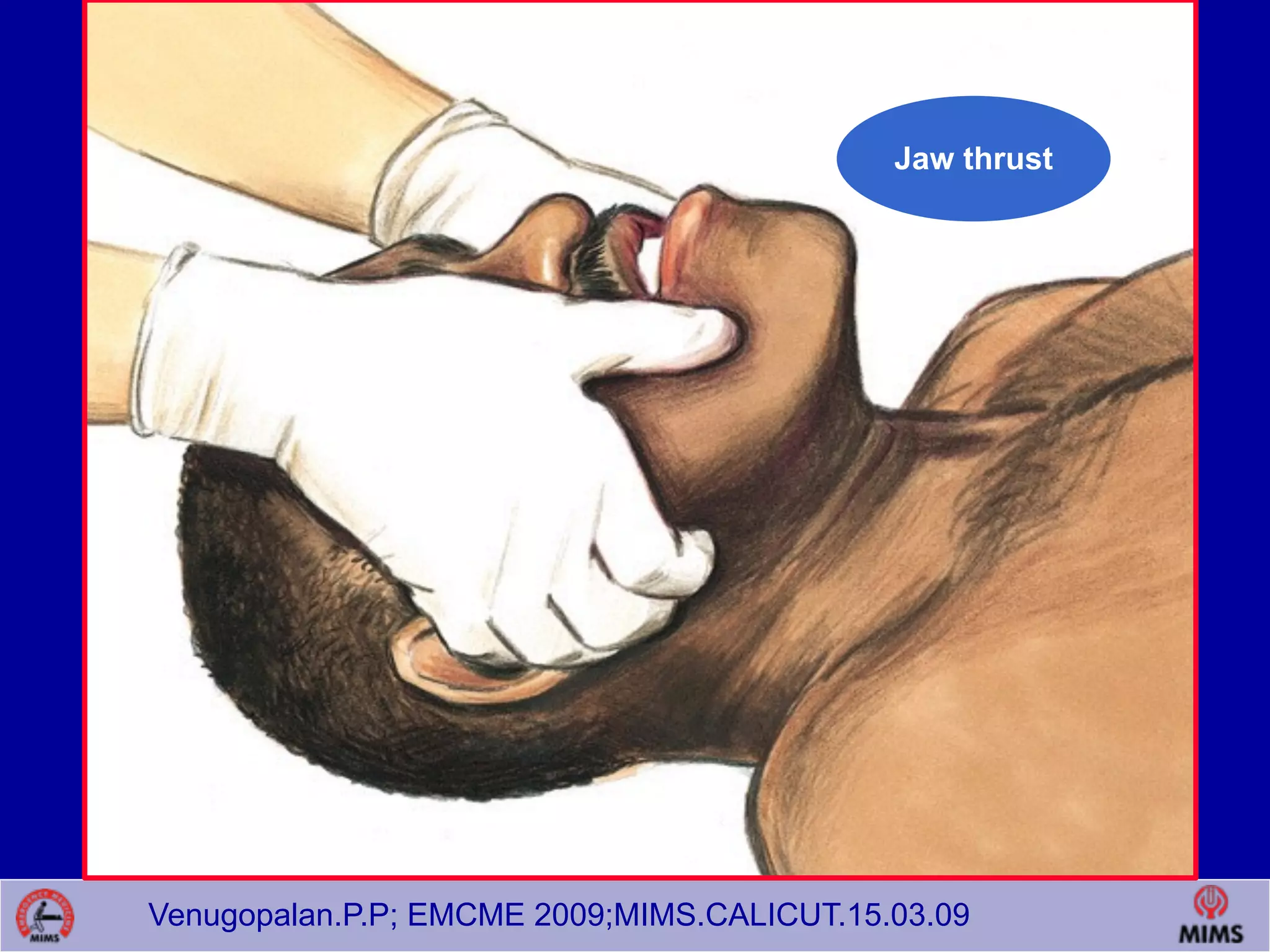 Venugopalan.P.P; EMCME 2009;MIMS.CALICUT.15.03.09
Jaw thrust
 