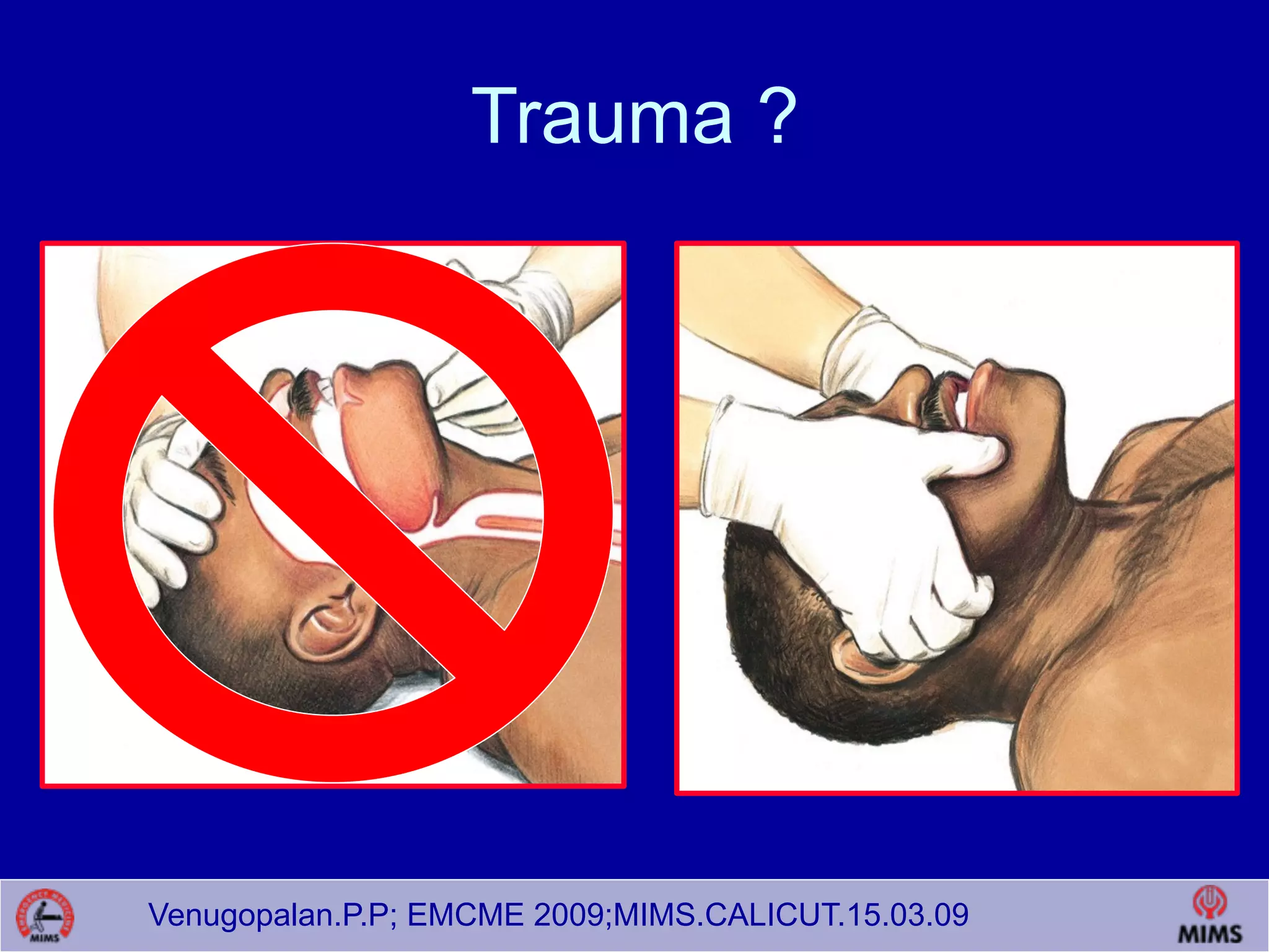 Venugopalan.P.P; EMCME 2009;MIMS.CALICUT.15.03.09
Trauma ?
 