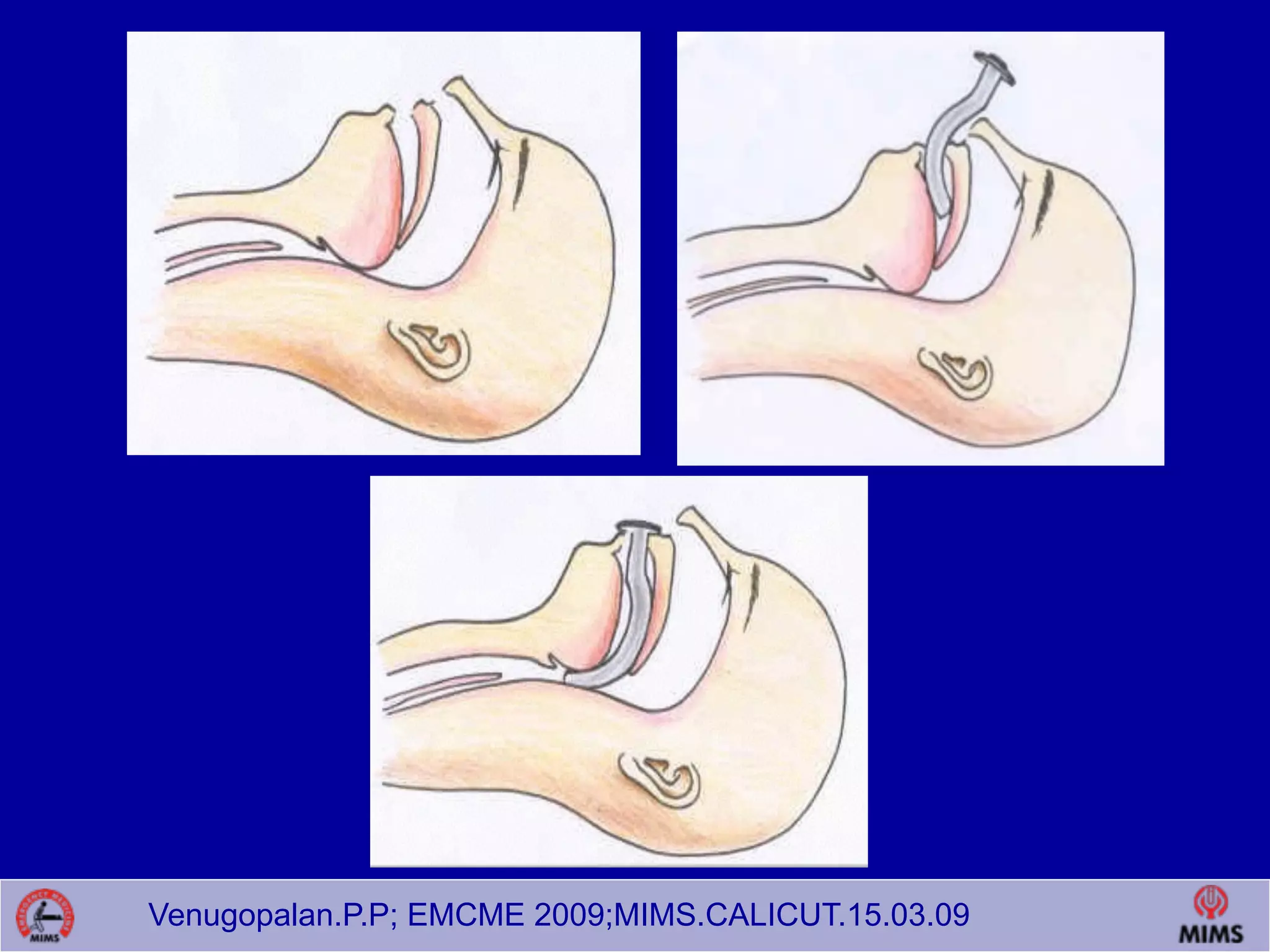 Venugopalan.P.P; EMCME 2009;MIMS.CALICUT.15.03.09
 