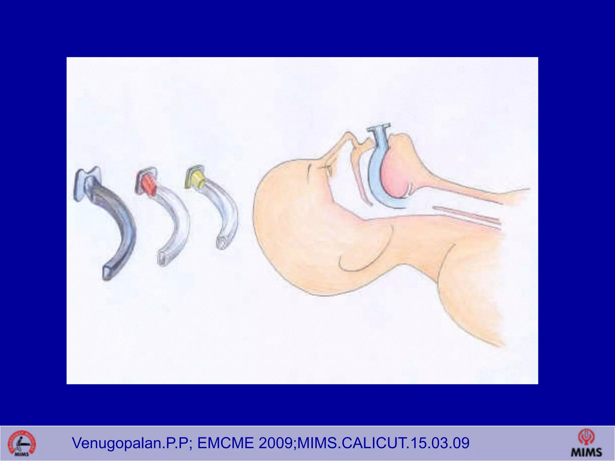 Venugopalan.P.P; EMCME 2009;MIMS.CALICUT.15.03.09
 
