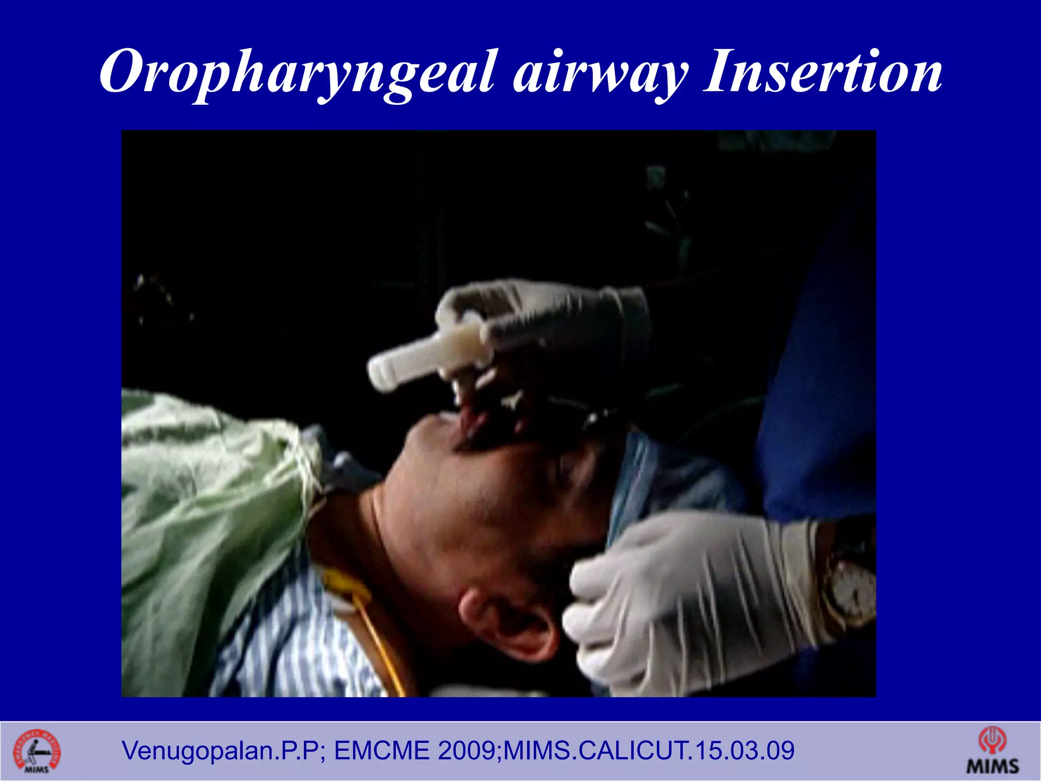 Venugopalan.P.P; EMCME 2009;MIMS.CALICUT.15.03.09
Oropharyngeal airway Insertion
 