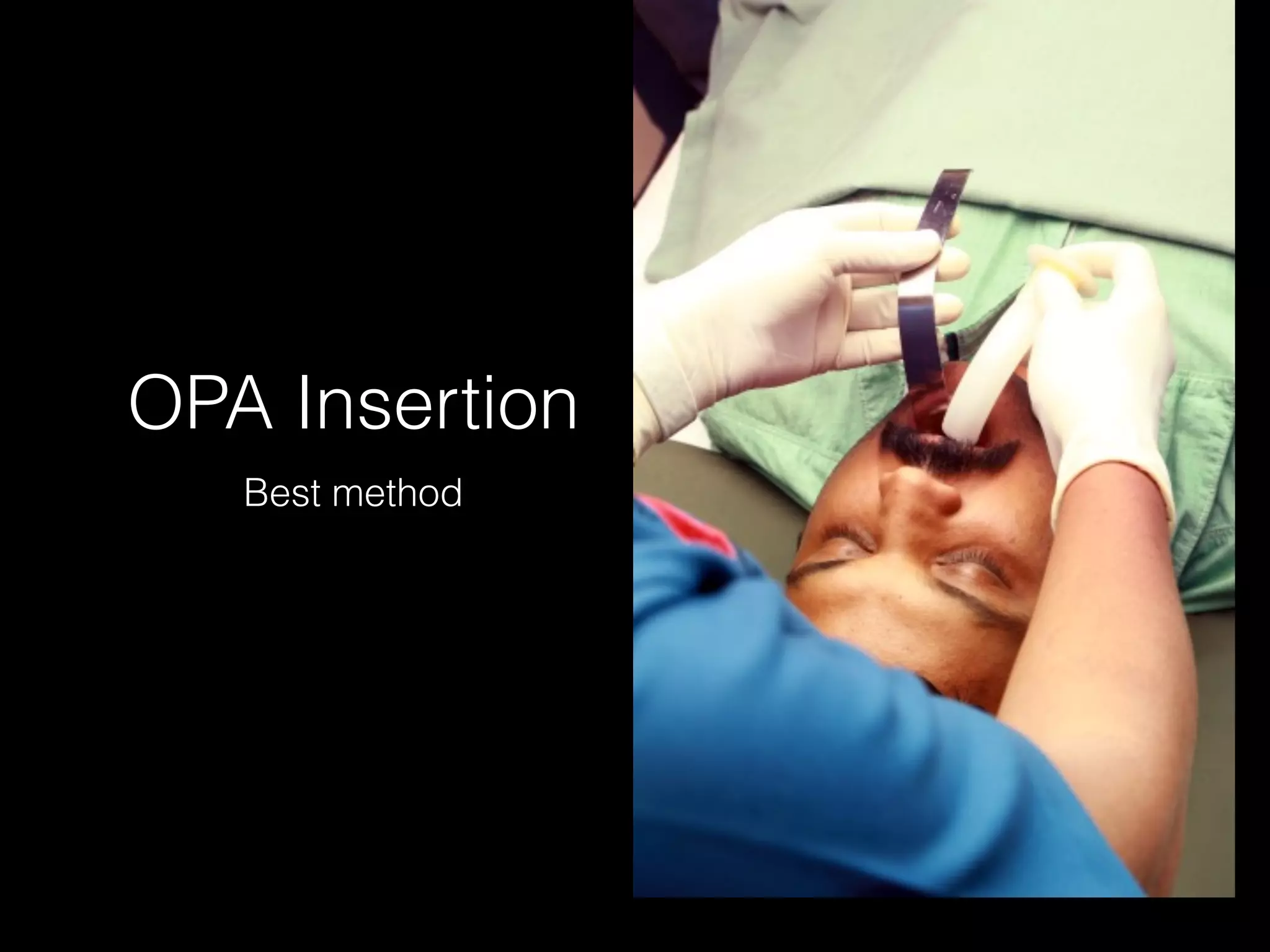 OPA Insertion
Best method
 