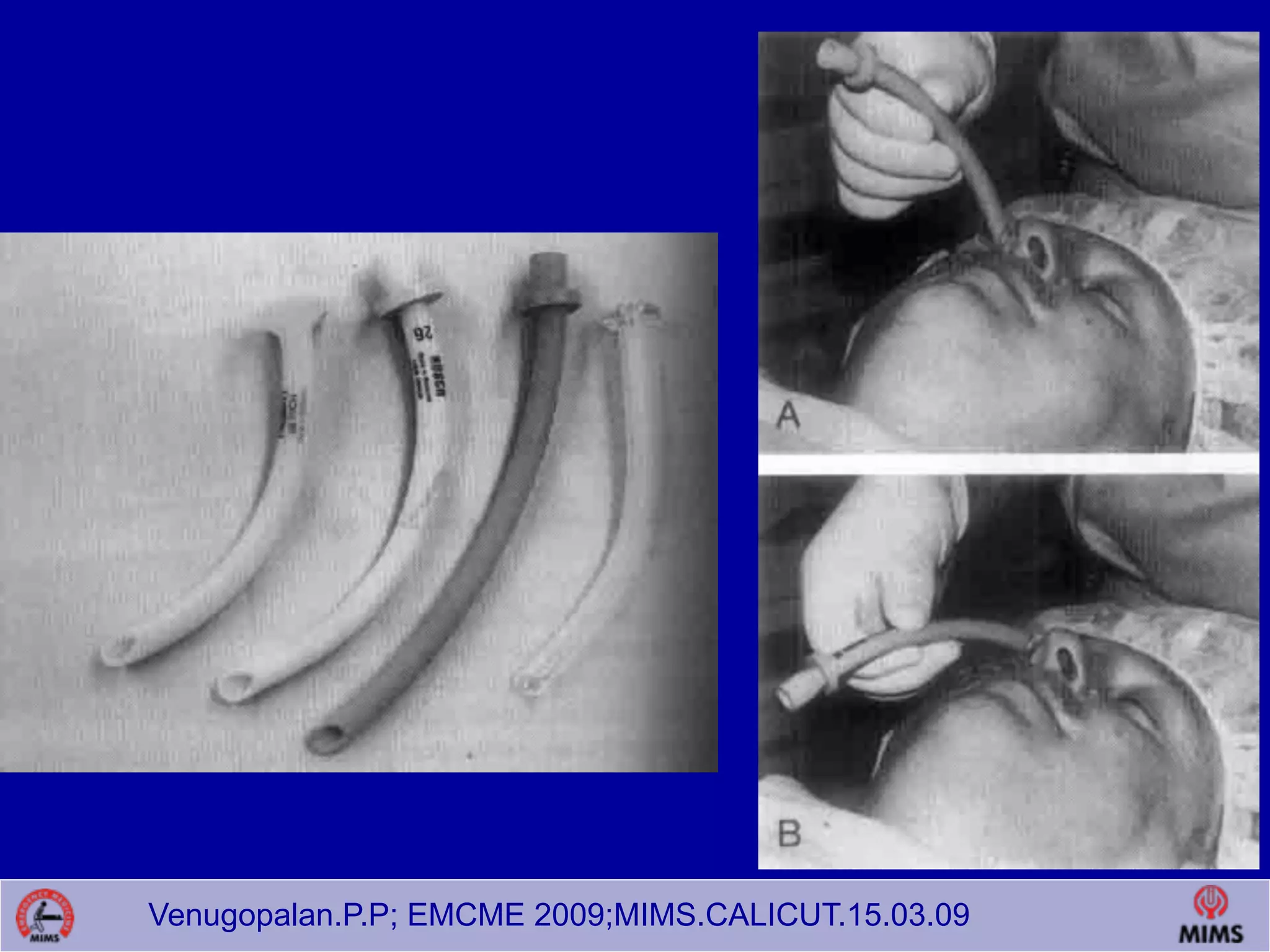 Venugopalan.P.P; EMCME 2009;MIMS.CALICUT.15.03.09
 