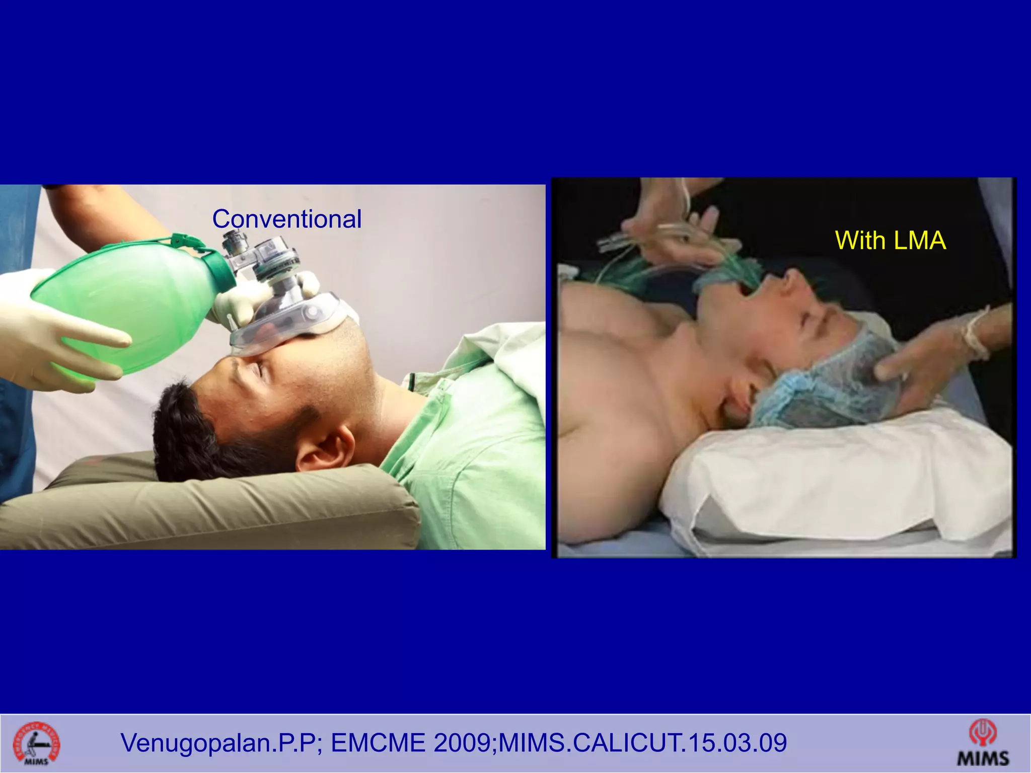 Venugopalan.P.P; EMCME 2009;MIMS.CALICUT.15.03.09
Conventional
With LMA
 
