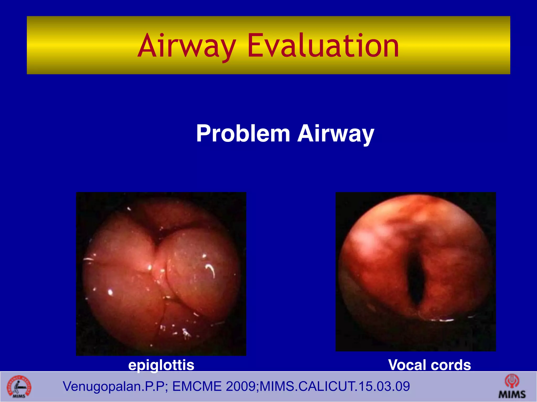Venugopalan.P.P; EMCME 2009;MIMS.CALICUT.15.03.09
Airway Evaluation
Problem Airway
epiglottis Vocal cords
 