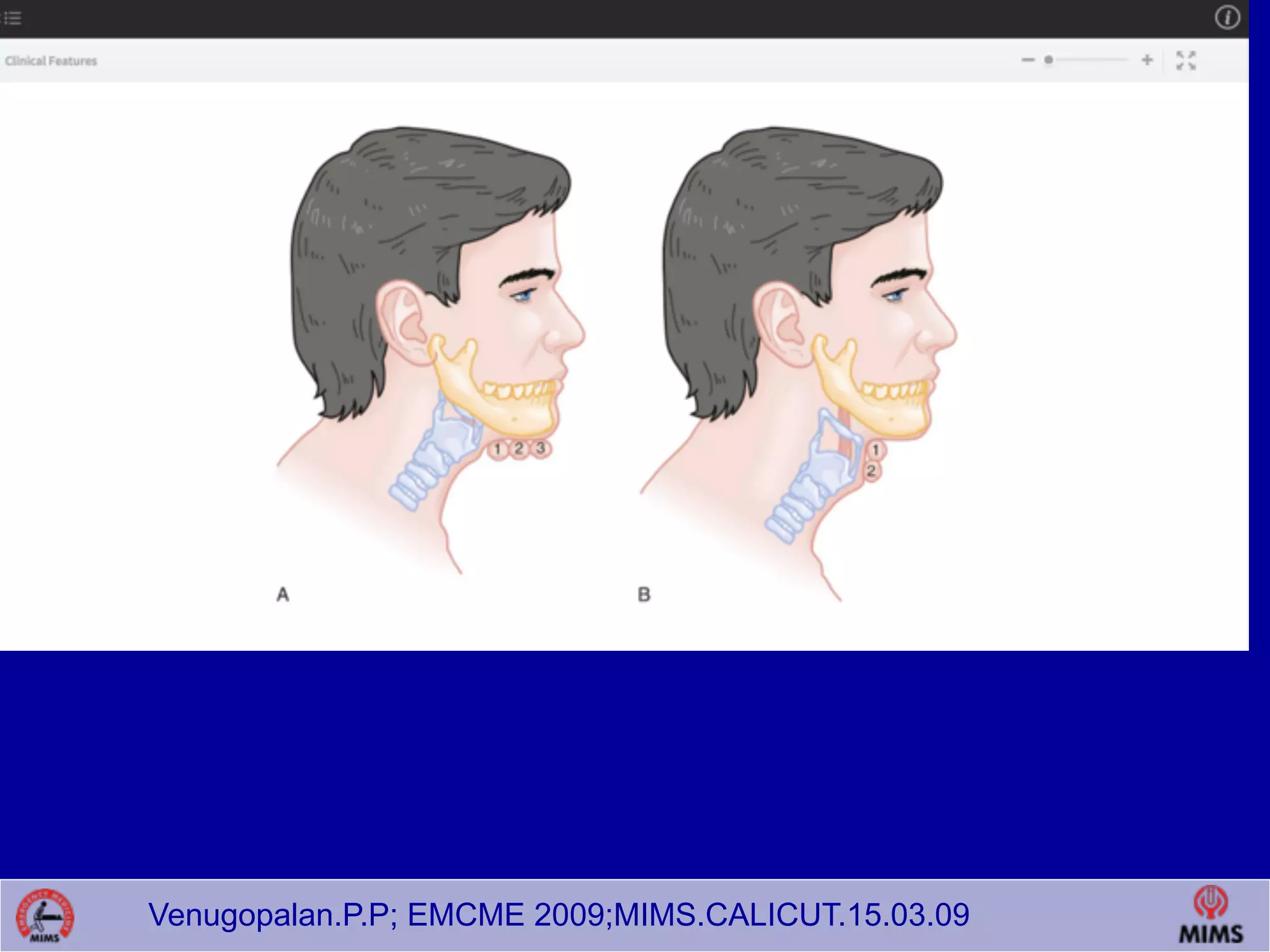 Venugopalan.P.P; EMCME 2009;MIMS.CALICUT.15.03.09
Evaluate 3-3-2.
 