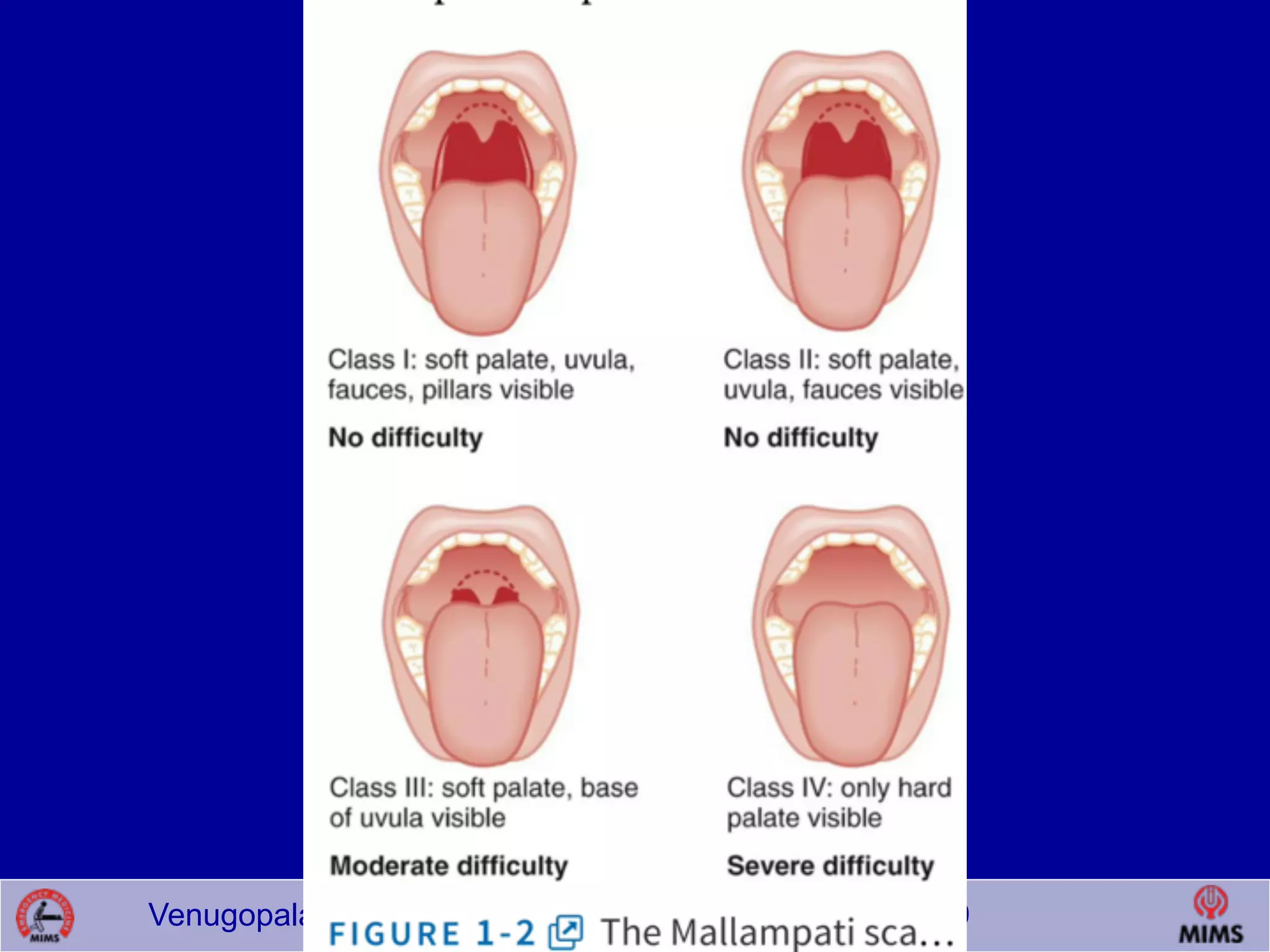 Venugopalan.P.P; EMCME 2009;MIMS.CALICUT.15.03.09
 