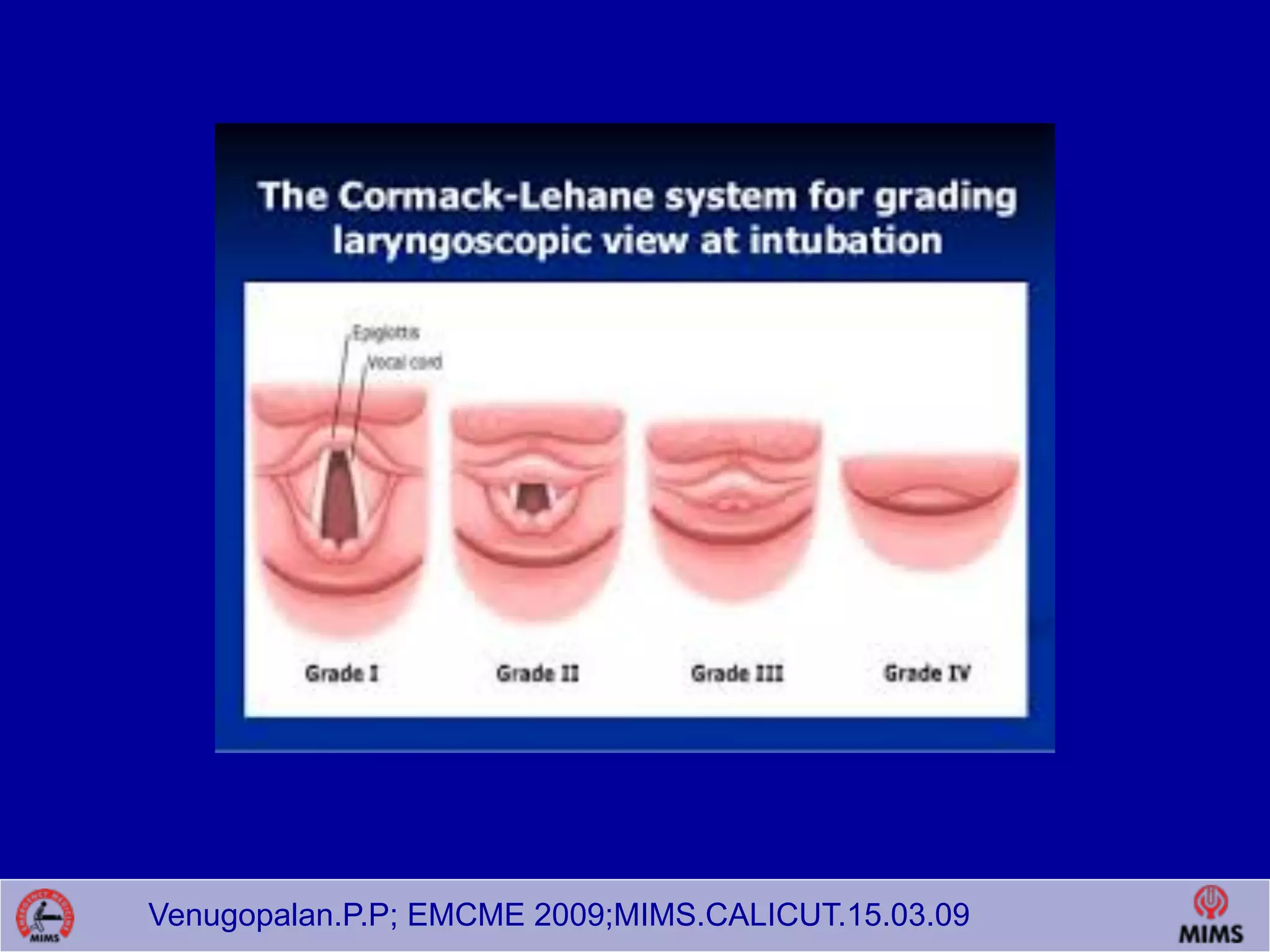 Venugopalan.P.P; EMCME 2009;MIMS.CALICUT.15.03.09
 