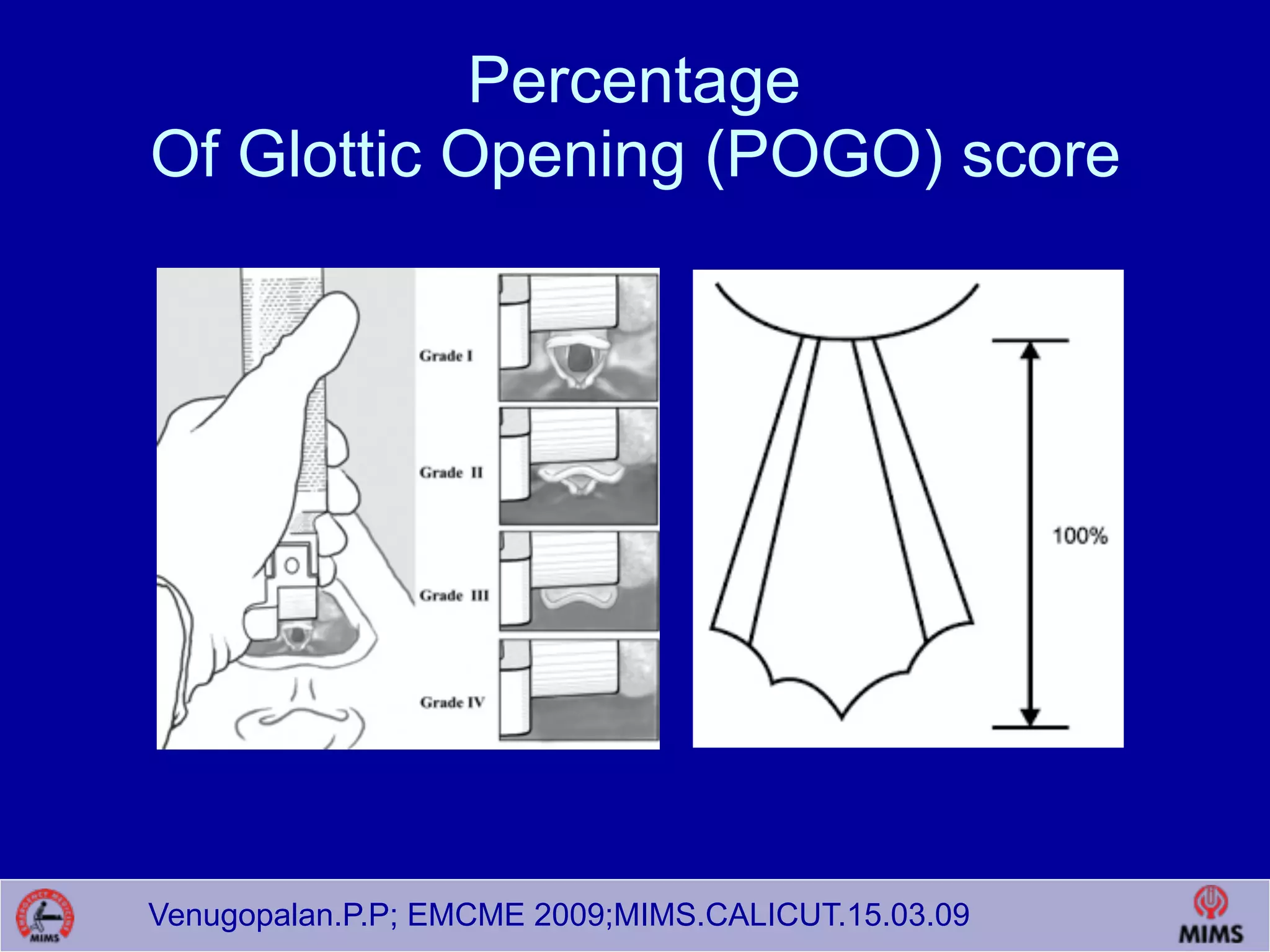 Venugopalan.P.P; EMCME 2009;MIMS.CALICUT.15.03.09
Percentage
Of Glottic Opening (POGO) score
 