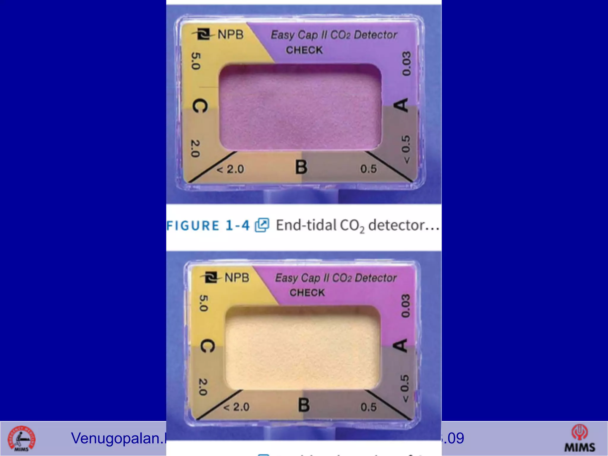 Venugopalan.P.P; EMCME 2009;MIMS.CALICUT.15.03.09
 