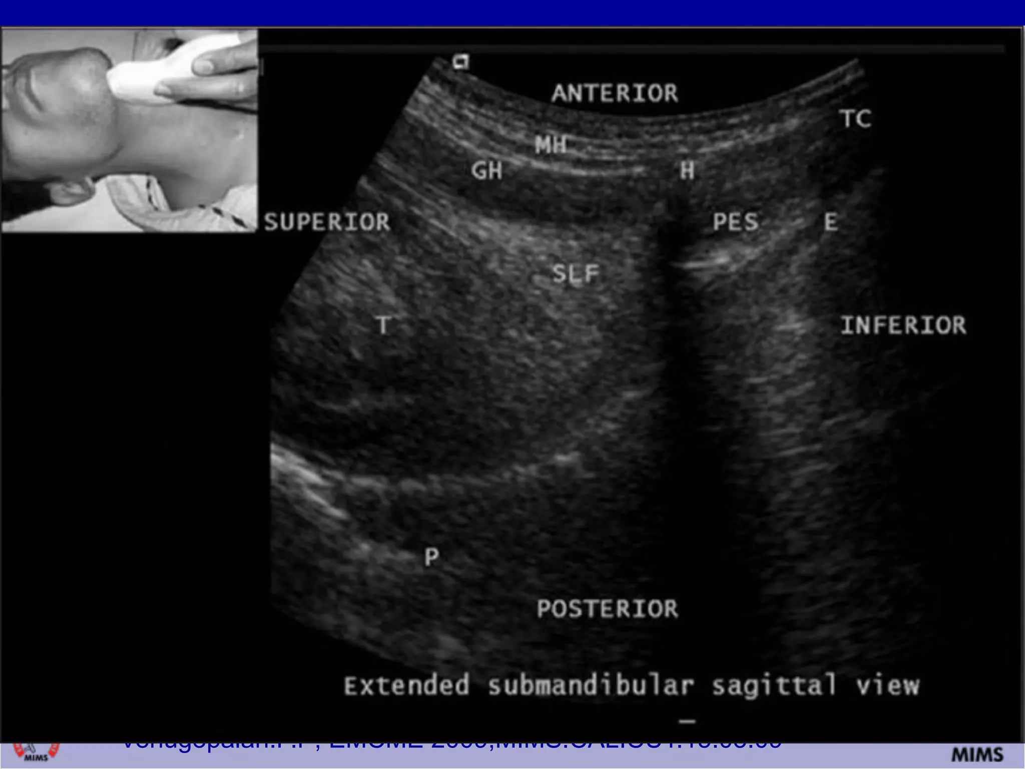 Venugopalan.P.P; EMCME 2009;MIMS.CALICUT.15.03.09
 
