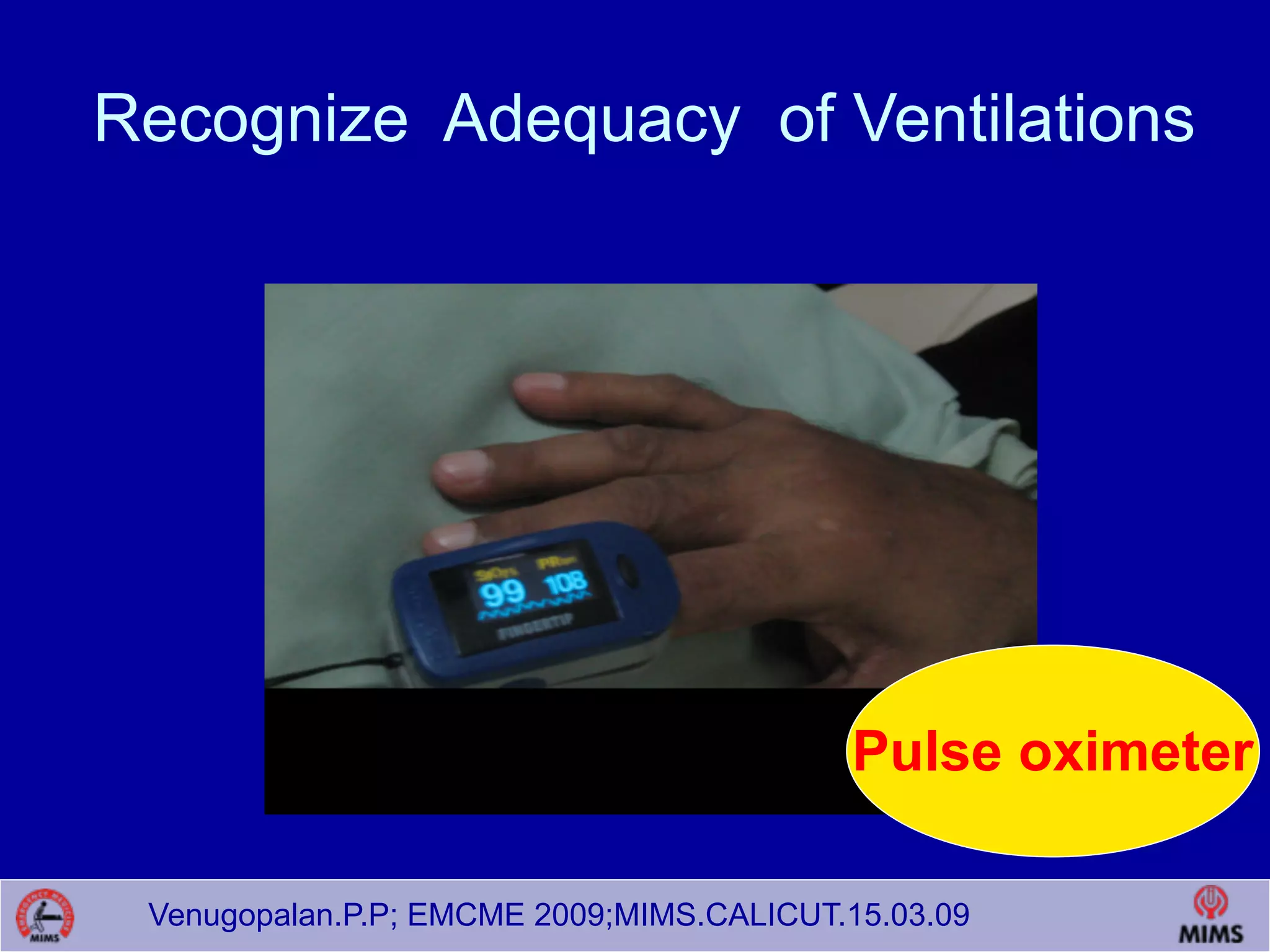 Venugopalan.P.P; EMCME 2009;MIMS.CALICUT.15.03.09
Recognize Adequacy of Ventilations
Pulse oximeter
 