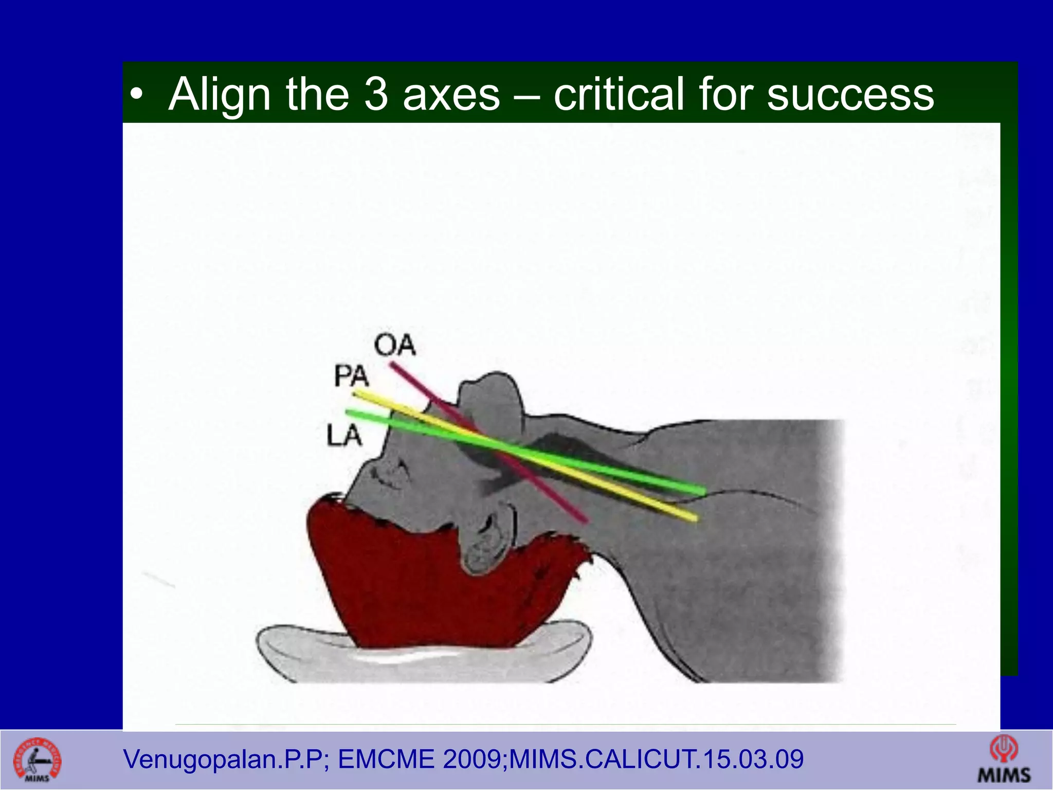 Venugopalan.P.P; EMCME 2009;MIMS.CALICUT.15.03.09
• Align the 3 axes – critical for success
• Sellick’s maneuver
 