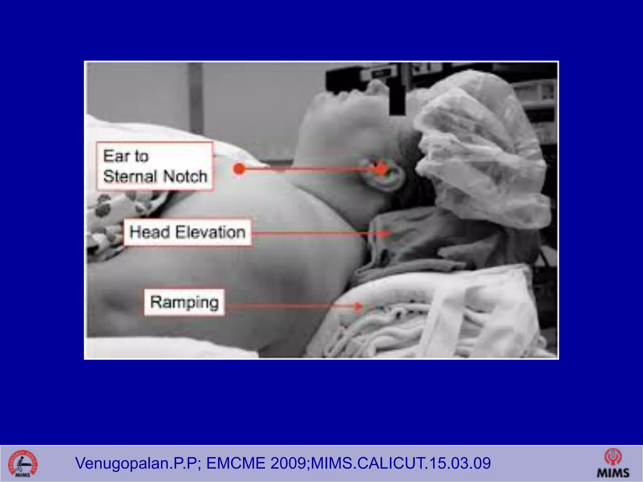 Venugopalan.P.P; EMCME 2009;MIMS.CALICUT.15.03.09
 