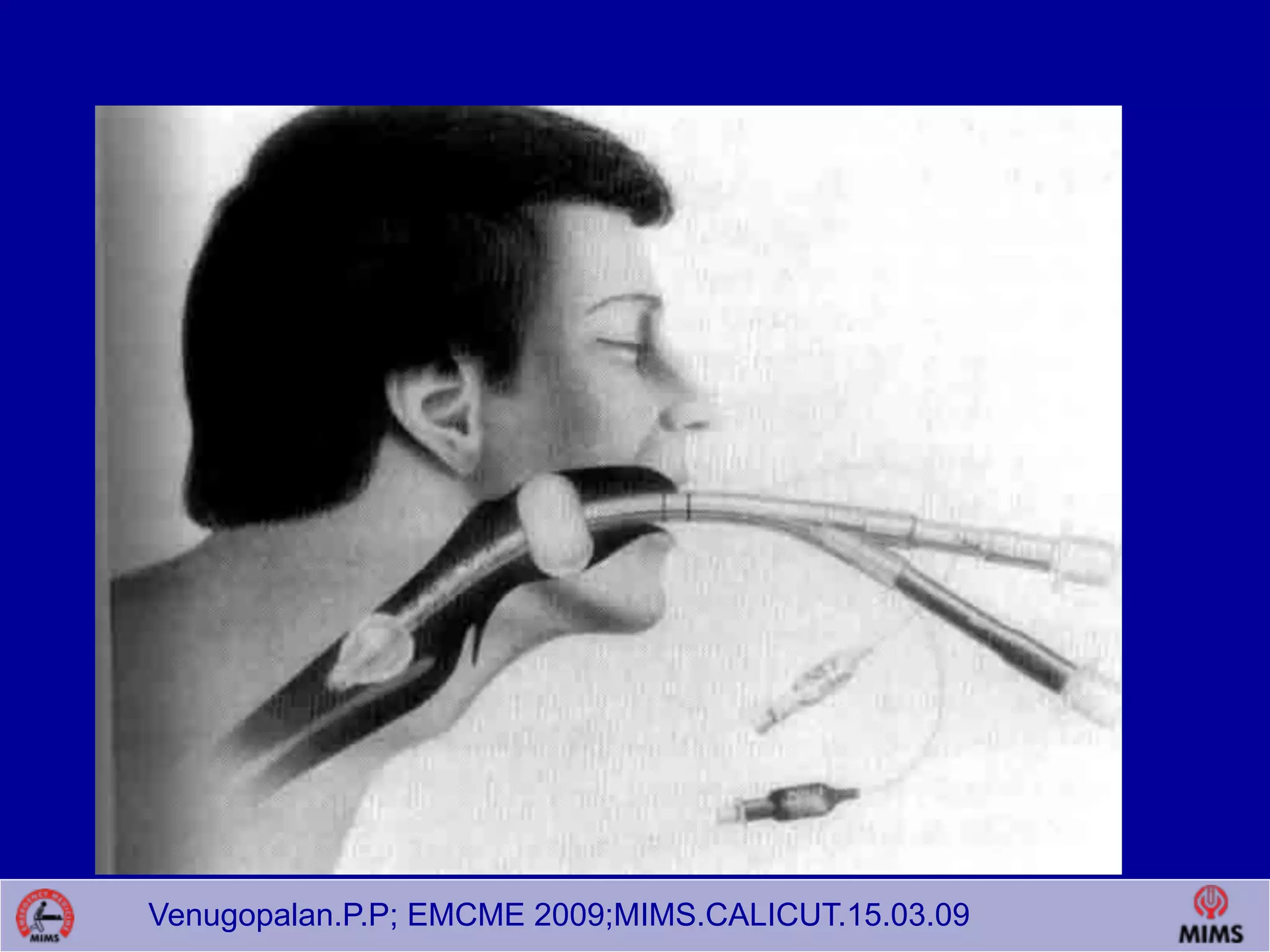 Venugopalan.P.P; EMCME 2009;MIMS.CALICUT.15.03.09
 