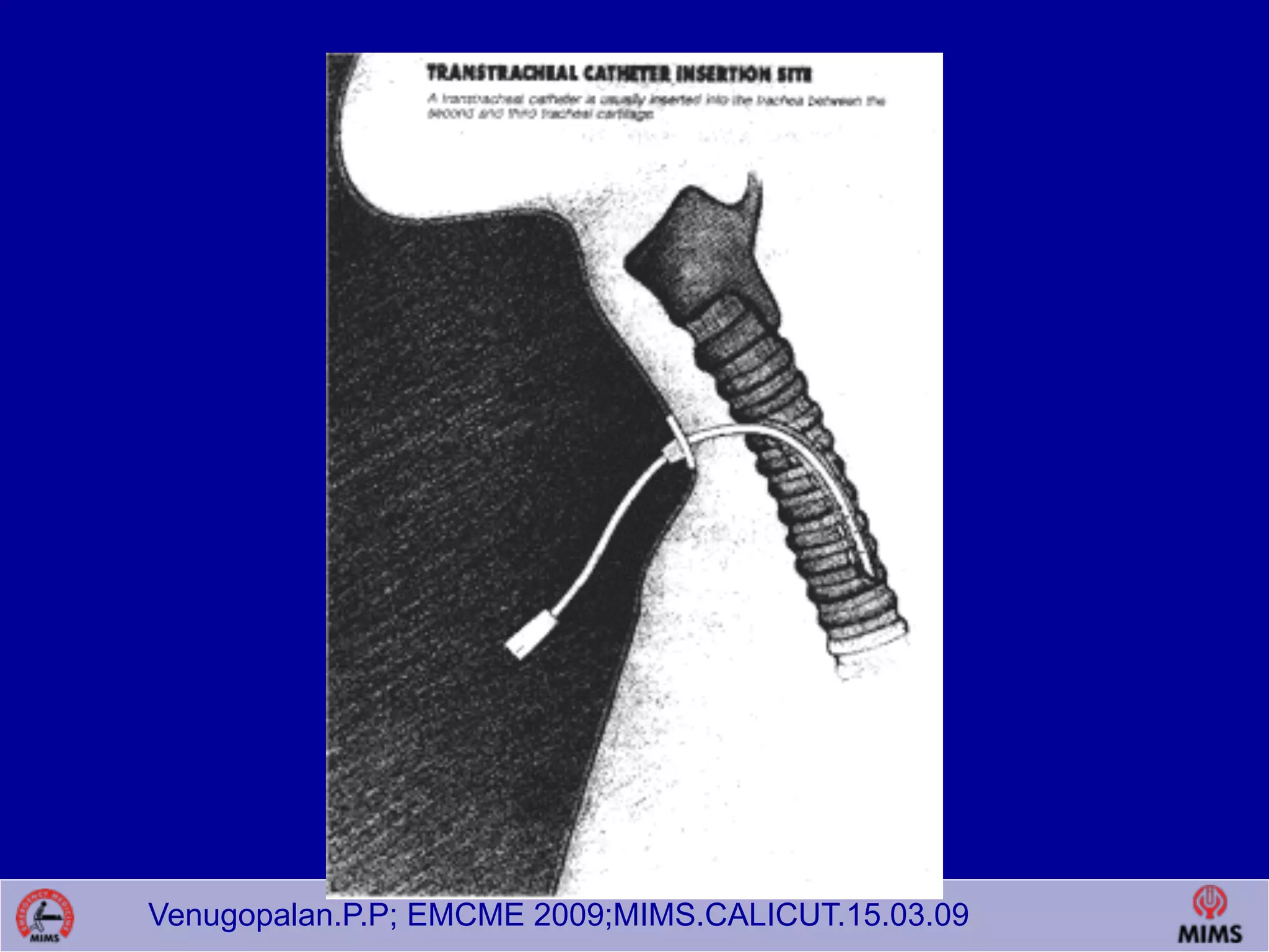 Venugopalan.P.P; EMCME 2009;MIMS.CALICUT.15.03.09
 