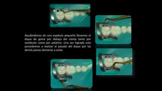 Ayudándonos del hilo dental logramos
pasar adecuadamente el dique de
goma por todas las piezas según la
técnica descrita a...