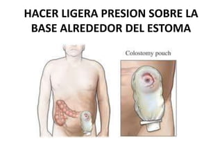 HACER LIGERA PRESION SOBRE LA
BASE ALREDEDOR DEL ESTOMA
 