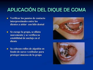 APLICACIÓN DEL DIQUE DE GOMA
 Verificar los puntos de contacto
interproximales entre los
dientes a aislar con hilo dental...