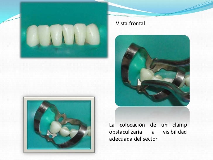 Aislamiento del campo operatorio en operatoria dental Aislamiento del campo operatorio en operatoria dental