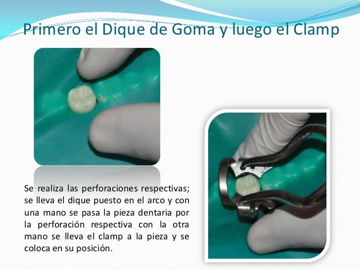 Aislamiento del campo operatorio en operatoria dental
